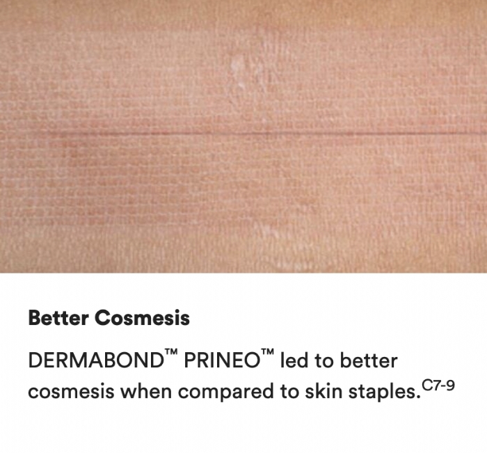 Ethicon DERMABOND® Topical Skin Adhesive – 2-Octyl Cyanoacrylate – AHV12 (Box of 12)