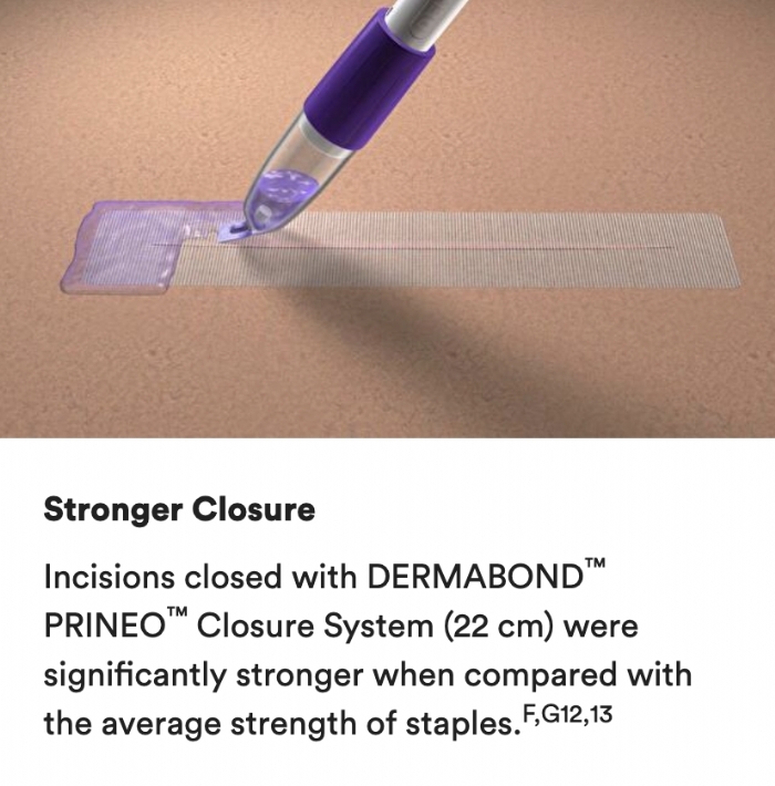 Ethicon DERMABOND PRINEO® 60cm Mesh Skin Closure System – 3.8mL Adhesive – CLR602 (Box of 2)