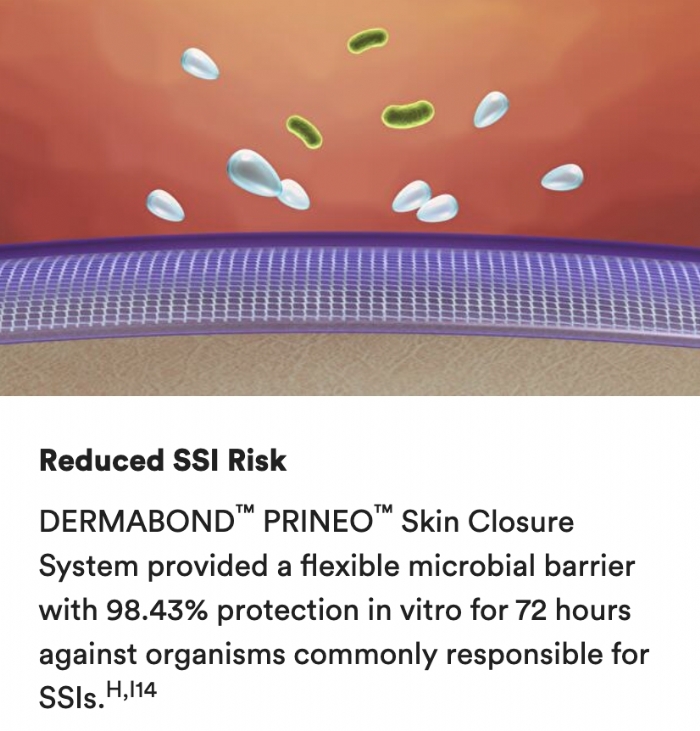 Ethicon DERMABOND PRINEO® 60cm Mesh Skin Closure System – 3.8mL Adhesive – CLR602 (Box of 2)