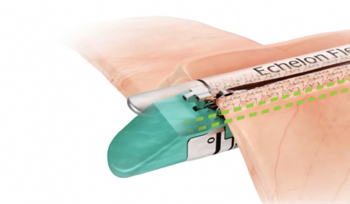 ECHELON FLEX™ GST System PLEE60A 60mm Powered Plus Stapler (Long)