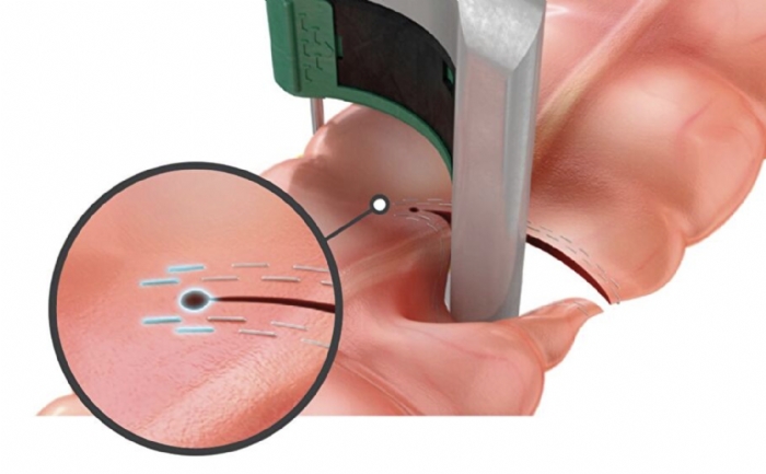 PROXIMATE® Reloadable Linear Stapler TX60B 60mm with Blue Reload