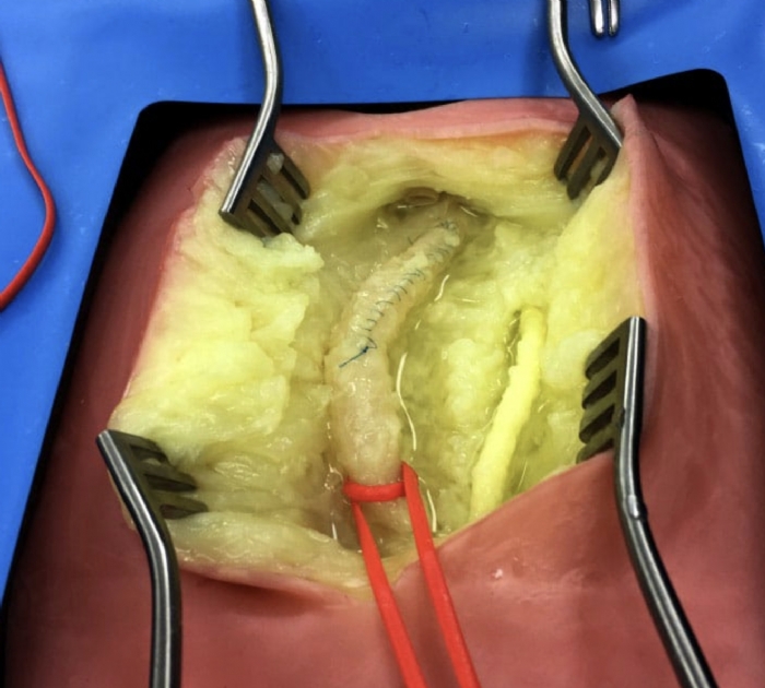 Embedded Femoral Groin Model | Femoral Endarterectomy Training Simulator