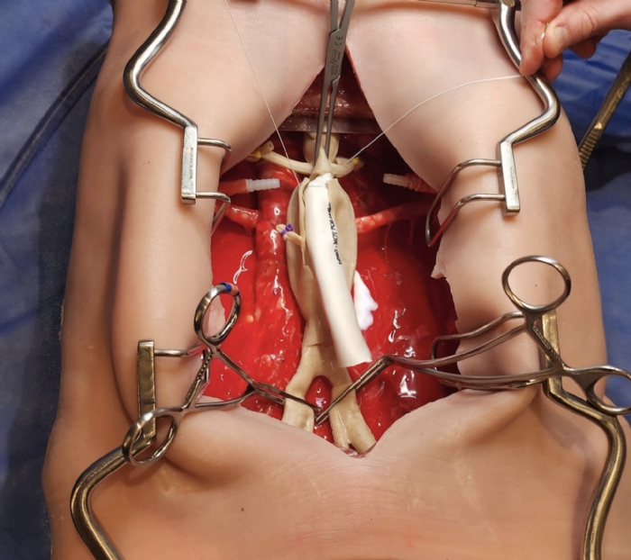 Abdominal Aortic Aneurysm Model | AAA Surgical Training Simulator