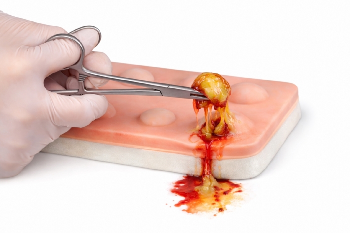 Simulated Skin Suture Pad for Incision & Drainage (I&D) Training – Abscess & Cyst Surgical Skills Practice Model