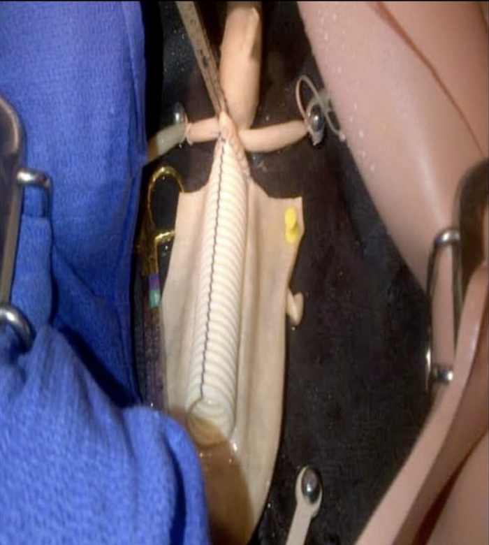 Abdominal Aortic Aneurysm (AAA) Abdomen Simulator – Vascular Surgery Training Model with Pulsatile Flow System – Open Aneurysm Repair Training – (Professional Use)